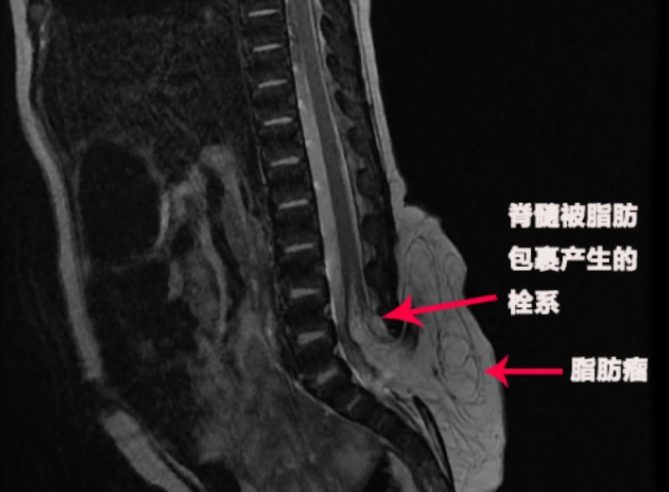 當(dāng)心嬰兒尾骨處的異常現(xiàn)象 鼓包、小坑、多毛可能脊柱有大問題