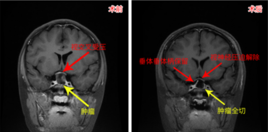 醫(yī)生媽媽：我要給我孩子找最好的顱咽管瘤手術(shù)團隊