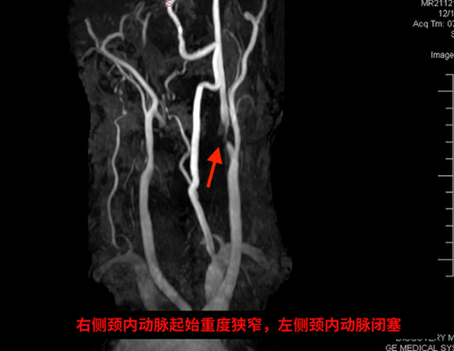 轉(zhuǎn)流管架起生命橋梁 切個小口把斑塊“揪”出來