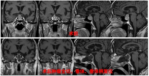  高齡是腦外科手術禁忌？三博腦科醫(yī)院86歲腦腫瘤患者術后3天順利出院