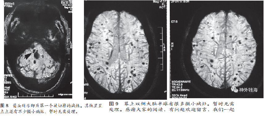 一例腦干海綿狀血管瘤的手術(shù)陷阱