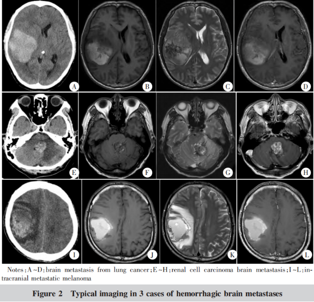 41例腦轉移瘤出血性瘤卒中的相關臨床因素分析1